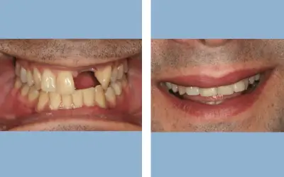 Before and After